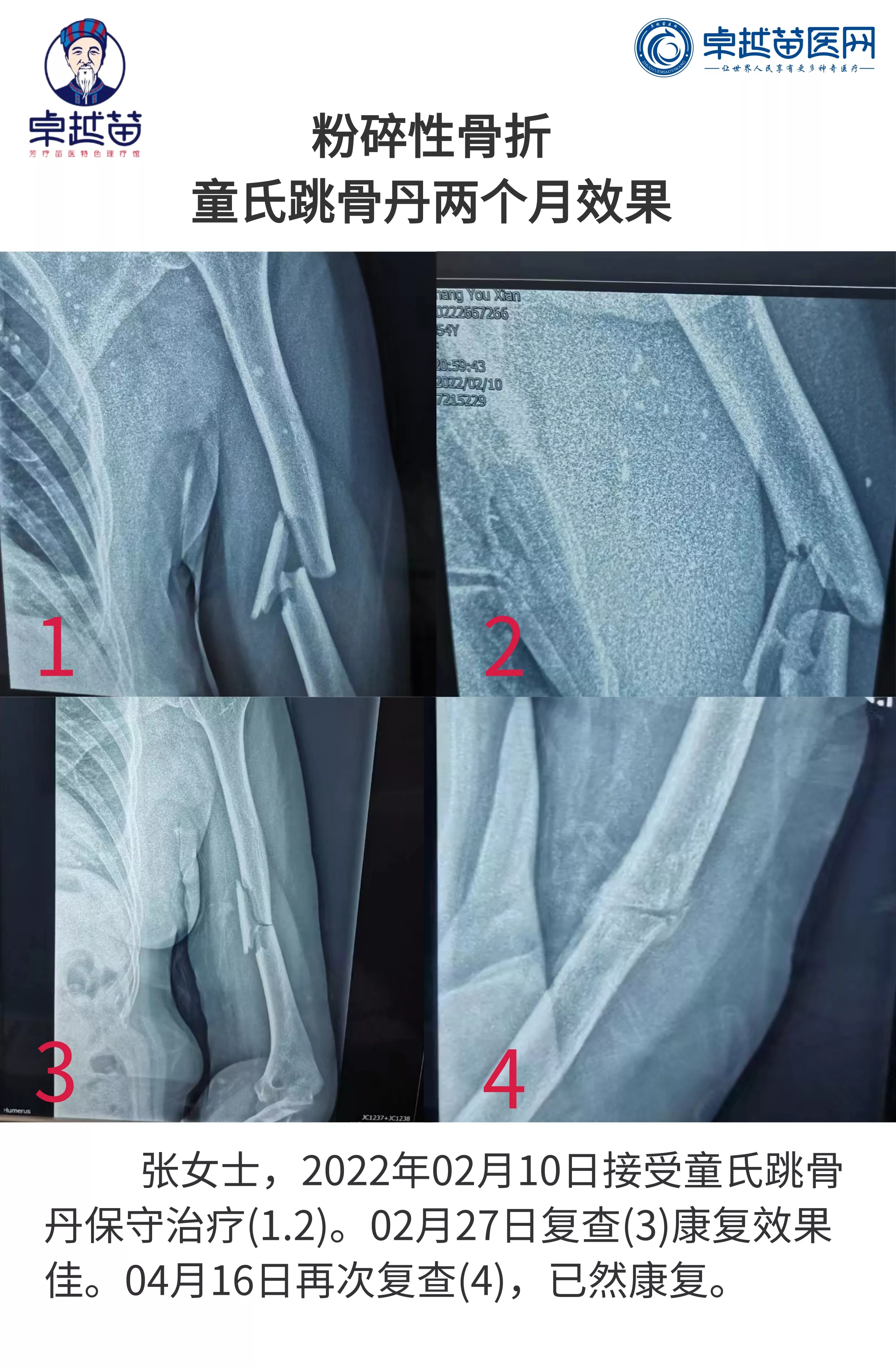 【案例】左手臂肱骨粉碎性骨折,服药就可以治疗! - 卓越苗医网